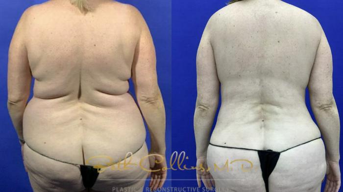 Braline back lift with back liposuction