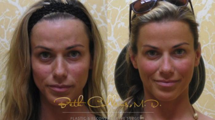 Before & After JUVÉDERM® Case 50 View #1 View in Guilford, CT