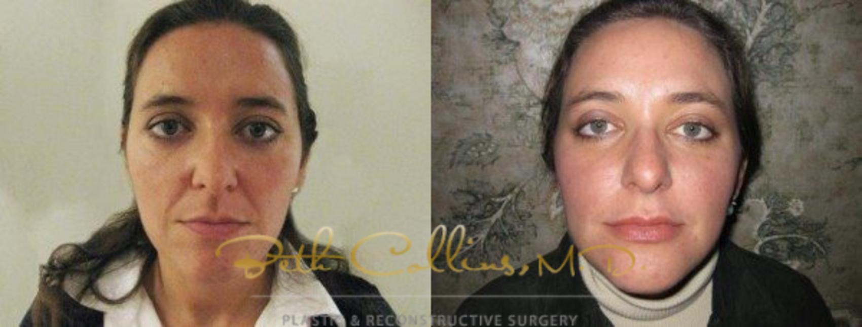 Before & After BOTOX® Cosmetic Case 51 View #1 View in Guilford, CT