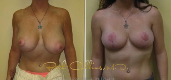 Before & After Breast Lift Case 22 View #1 View in Guilford, CT