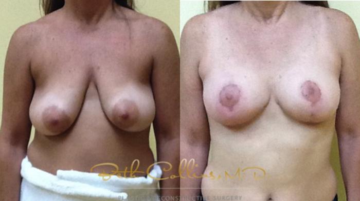 Before & After Breast Augmentation Case 35 View #1 View in Guilford, CT