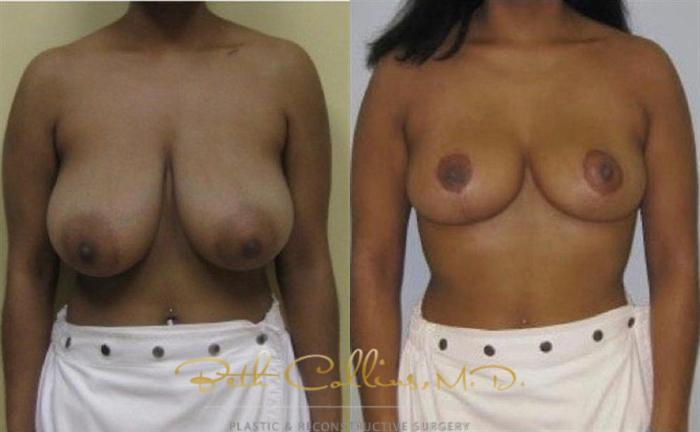 Before & After Breast Lift Case 42 View #1 View in Guilford, CT