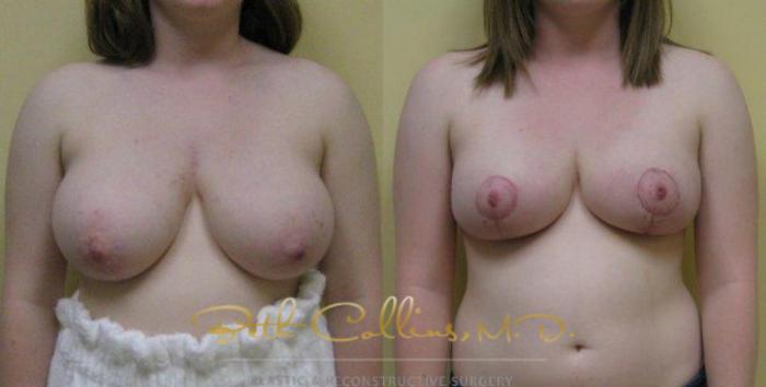 Before & After Breast Lift Case 47 View #1 View in Guilford, CT