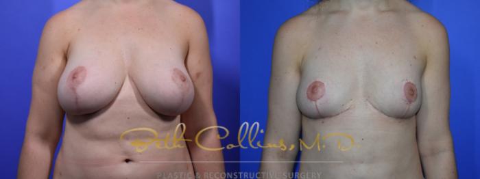Before & After Breast Lift Case 94 View #1 View in Guilford, CT