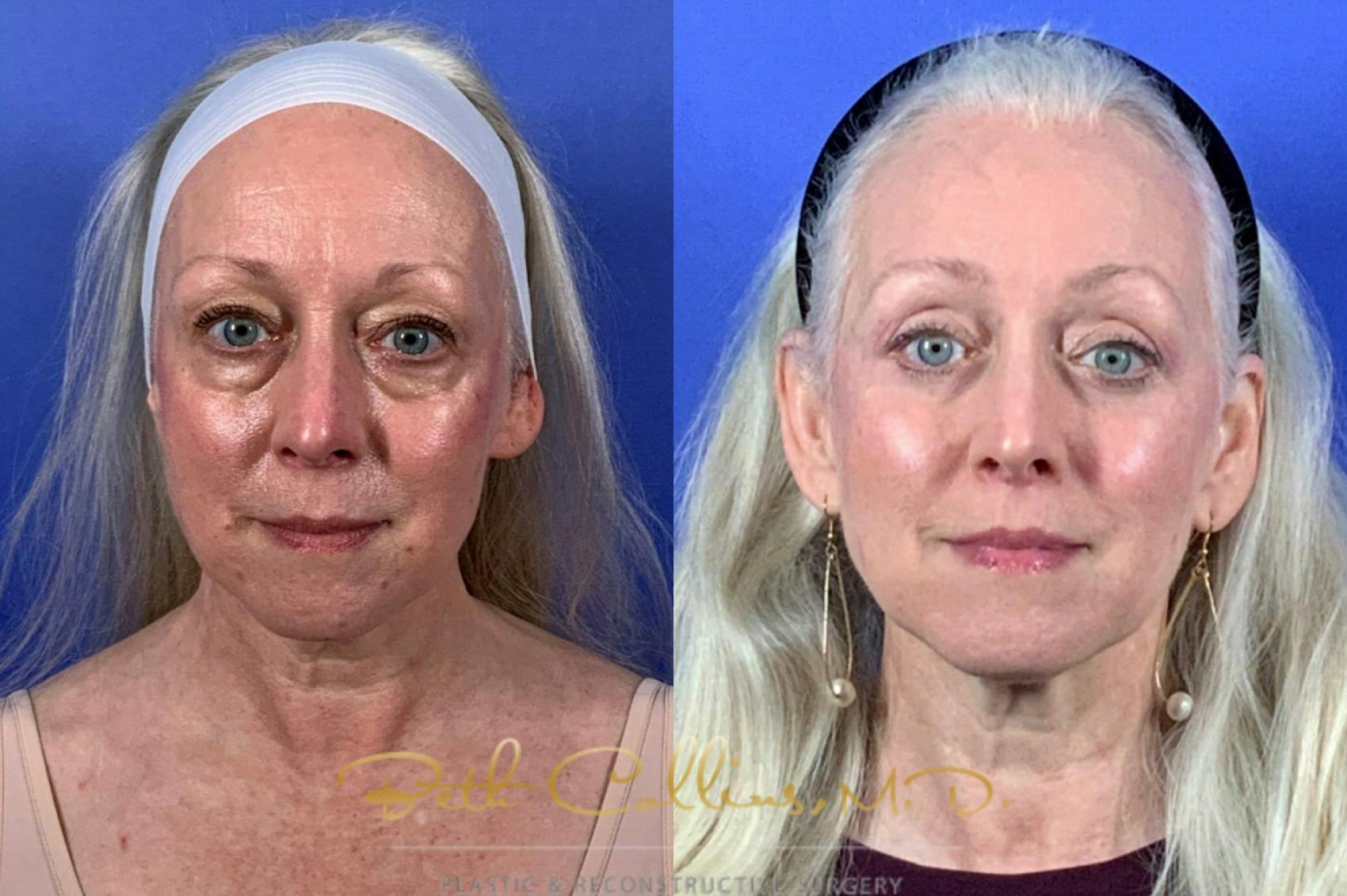 Upper and lower lid blepharoplasty with endoscopic brow lift
