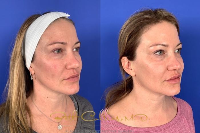 Before & After JUVÉDERM® Case 224 Right Oblique View in Guilford, CT