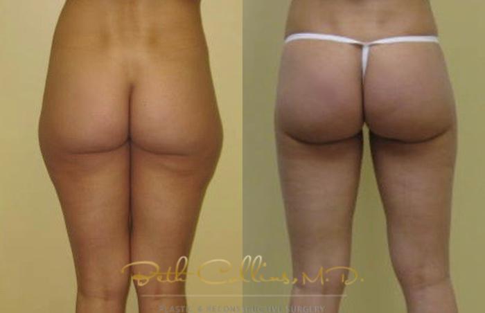 Before & After Liposuction Case 8 View #1 View in Guilford, CT