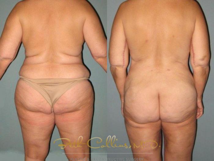 Before & After Liposuction Case 9 View #1 View in Guilford, CT