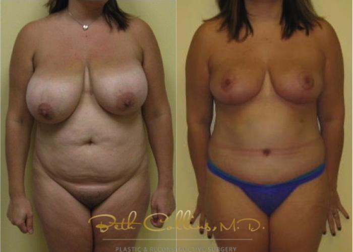 Before & After Breast Lift Case 114 View #1 View in Guilford, CT