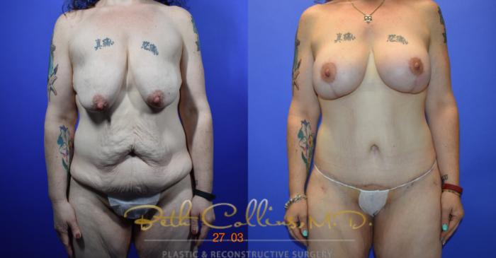 Before & After Breast Augmentation Case 92 View #1 View in Guilford, CT