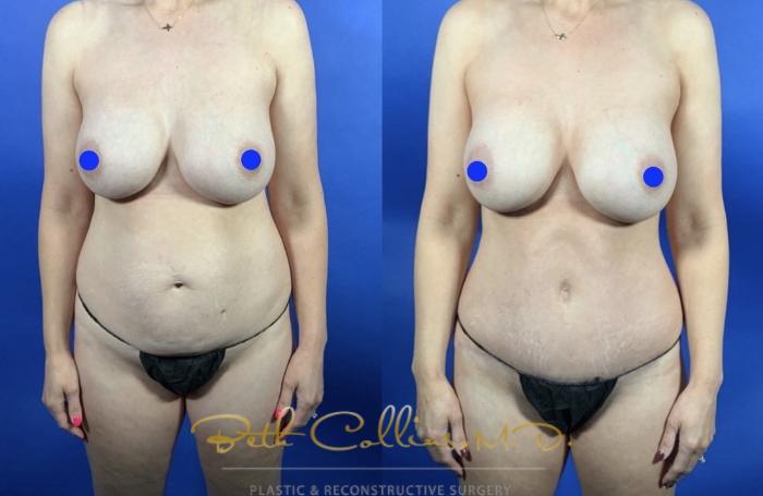 Before & After Tummy Tuck Case 236 Front View in Guilford, CT