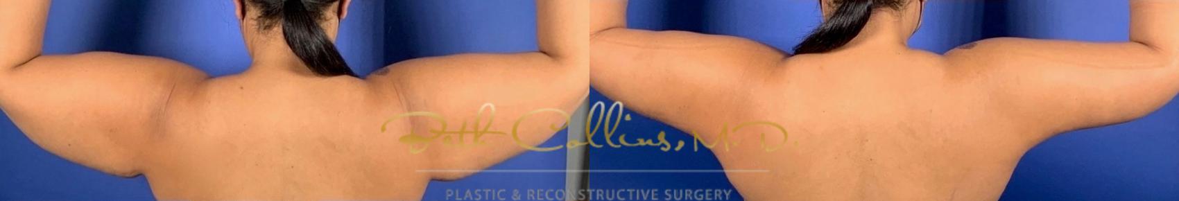 Before & After Arm Lift Case 196 Back View in Guilford, CT