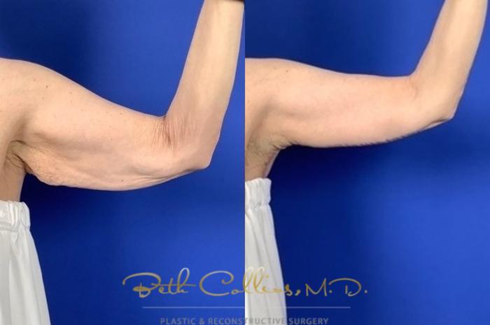 Before & After Arm Lift Case 197 Front - Left Arm View in Guilford, CT