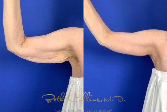 Before & After Arm Lift Case 197 Front - Right Arm View in Guilford, CT