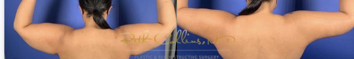 Brachioplasty with arm liposuction