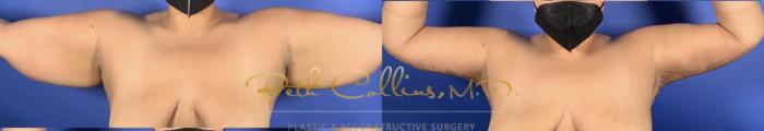 Brachioplasty with arm liposuction 