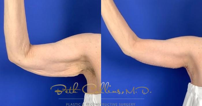 Before & After Arm Lift Case 233 Front - Left Arm View in Guilford, CT
