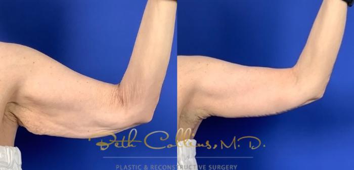 Before & After Arm Lift Case 233 Front - Right Arm View in Guilford, CT