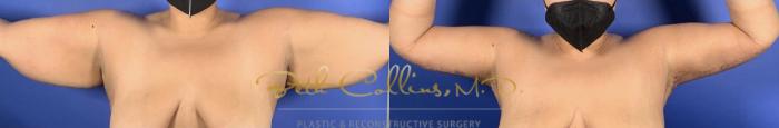 Before & After Arm Lift Case 240 Back View in Guilford, CT