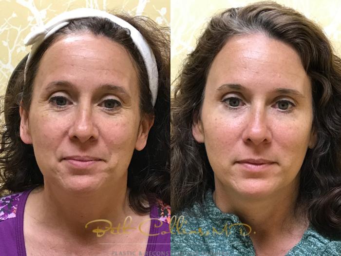 Before & After BOTOX® Cosmetic Case 133 Front View in Guilford, CT