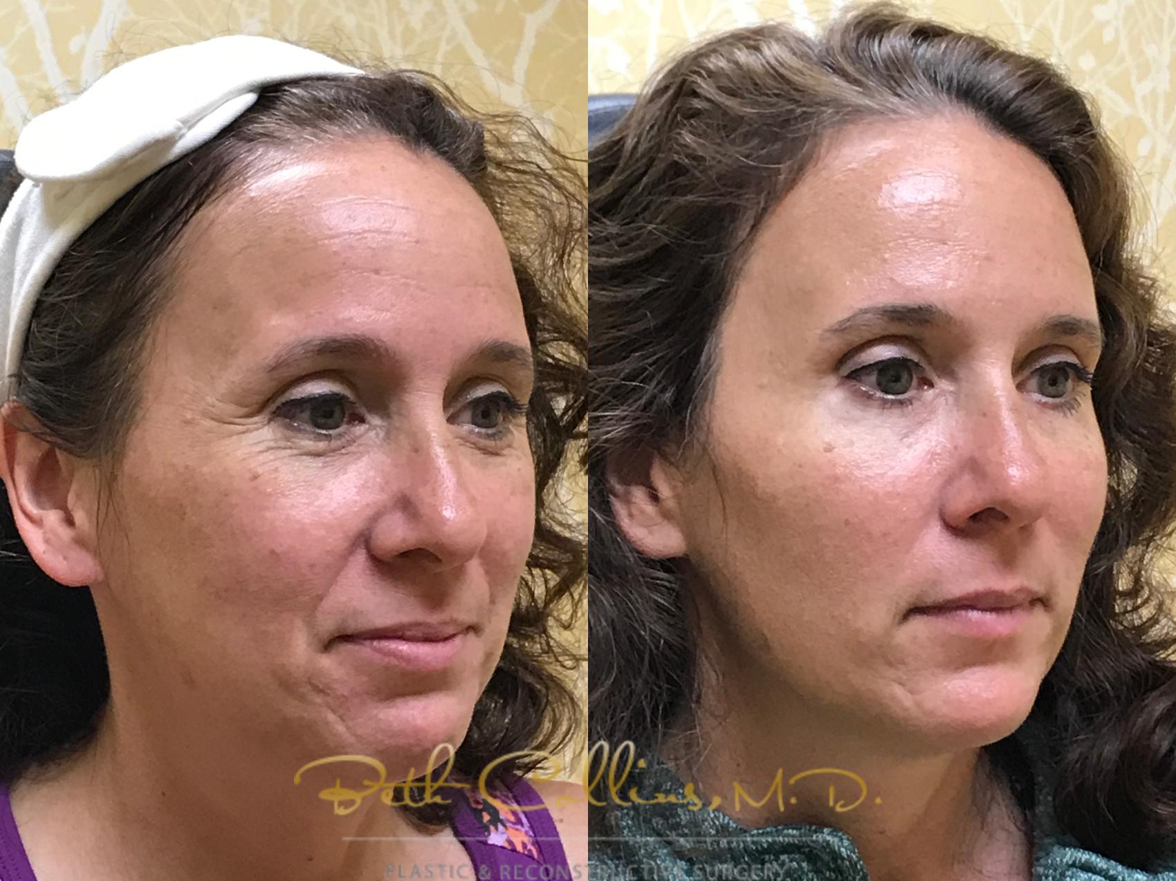 Before & After BOTOX® Cosmetic Case 133 Right Oblique View in Guilford, CT