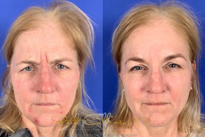 Before & After BOTOX® Cosmetic Case 222 Front - Brows View in Guilford, CT