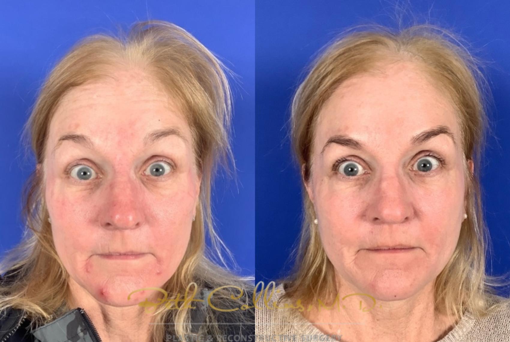 Before & After BOTOX® Cosmetic Case 222 Front View in Guilford, CT