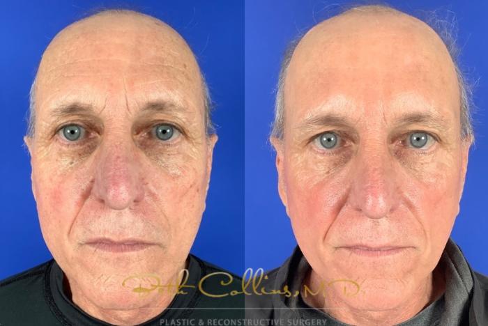 Before & After BOTOX® Cosmetic Case 223 Front - at rest View in Guilford, CT