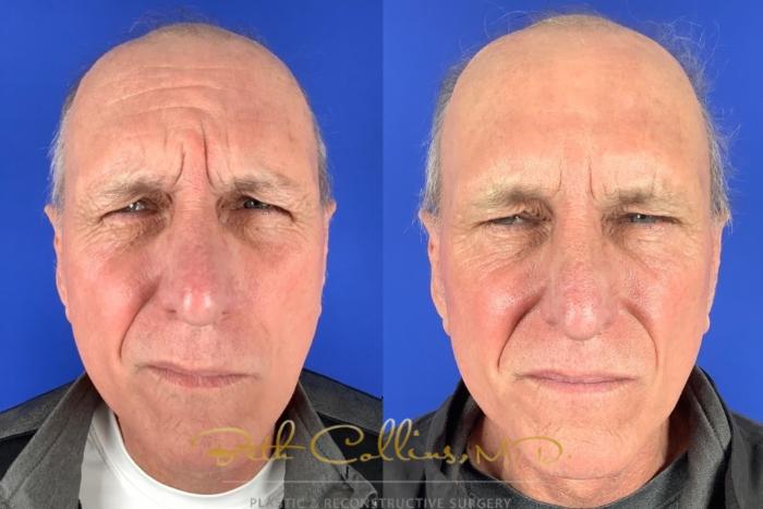 Before & After BOTOX® Cosmetic Case 223 Front - Brows View in Guilford, CT
