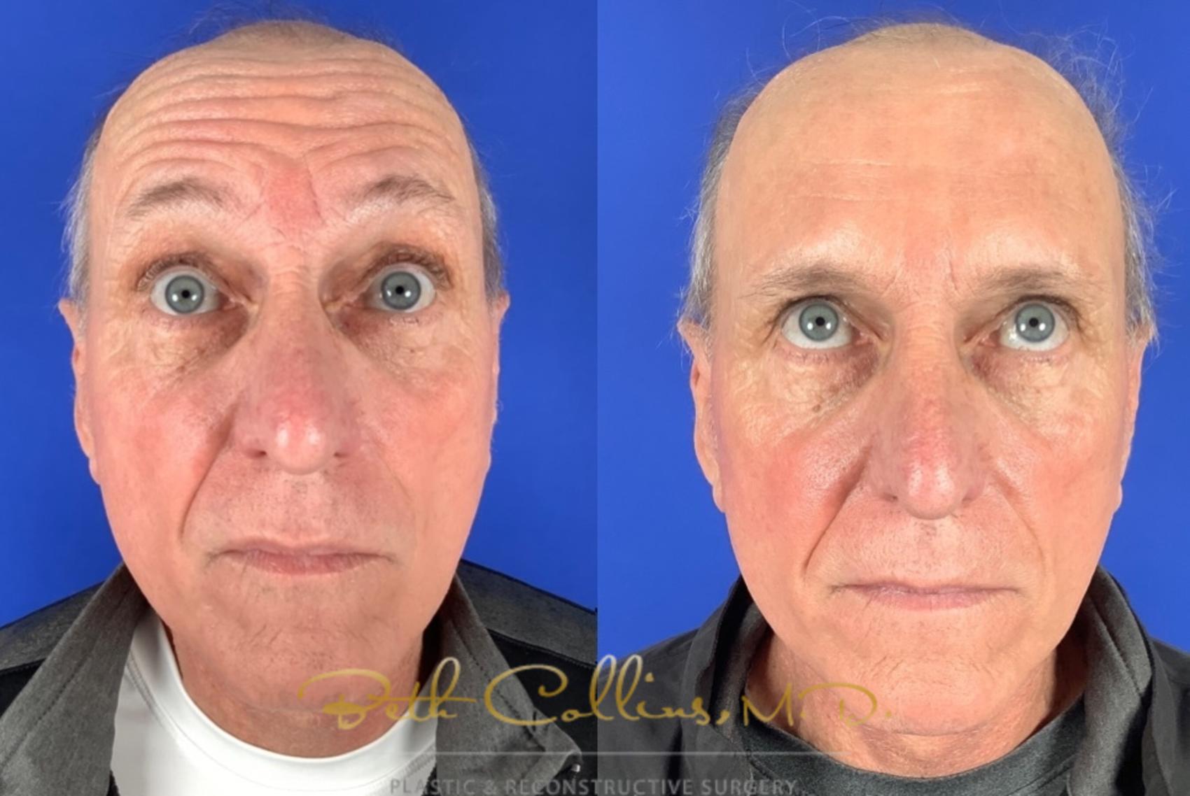 Before & After BOTOX® Cosmetic Case 223 Front View in Guilford, CT