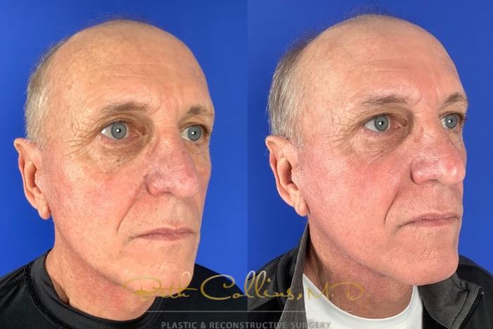 Before & After BOTOX® Cosmetic Case 223 Right Oblique View in Guilford, CT