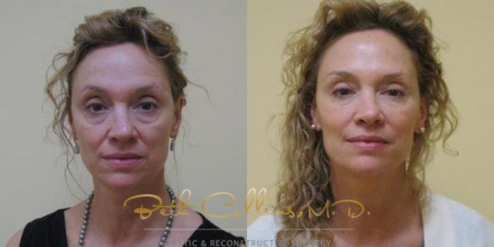 Before & After BOTOX® Cosmetic Case 48 View #1 View in Guilford, CT
