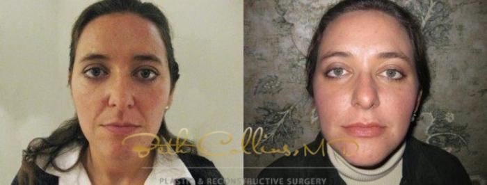 Before & After JUVÉDERM® Case 51 View #1 View in Guilford, CT