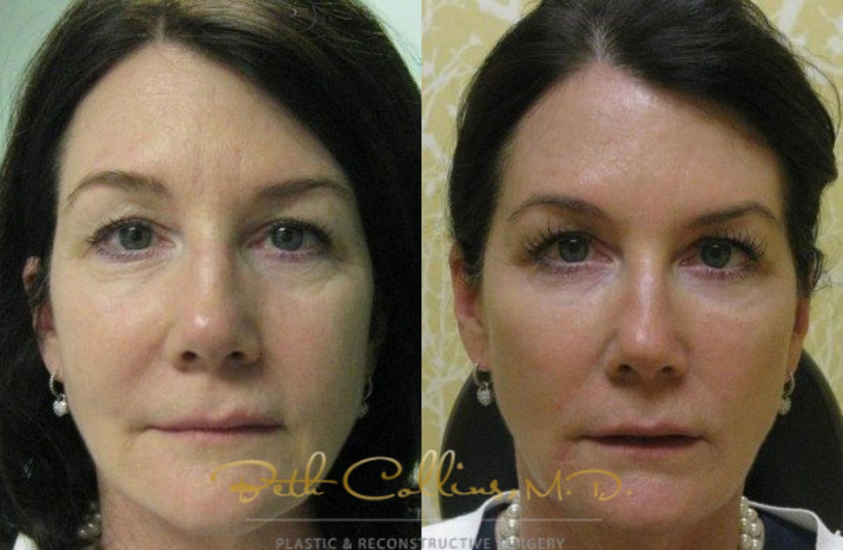 Before & After BOTOX® Cosmetic Case 53 View #1 View in Guilford, CT