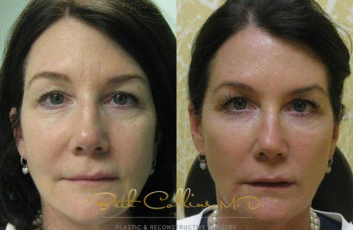 Before & After JUVÉDERM® Case 53 View #1 View in Guilford, CT