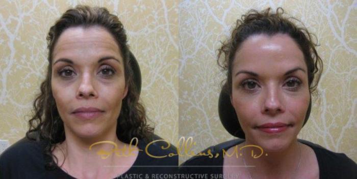 Before & After BOTOX® Cosmetic Case 54 View #1 View in Guilford, CT