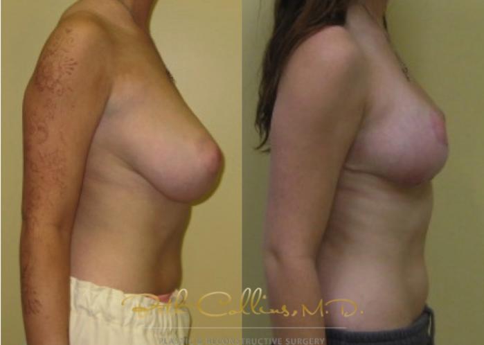 Before & After Breast Asymmetry Correction Case 22 View #2 View in Guilford, CT