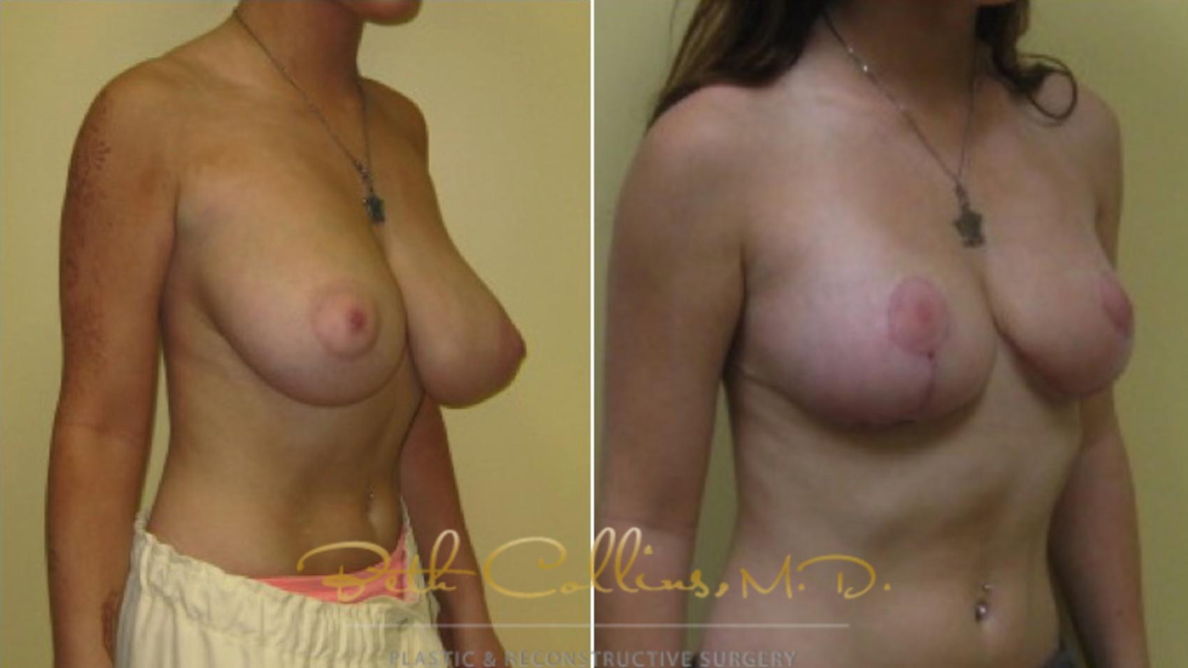 Before & After Breast Asymmetry Correction Case 22 View #3 View in Guilford, CT