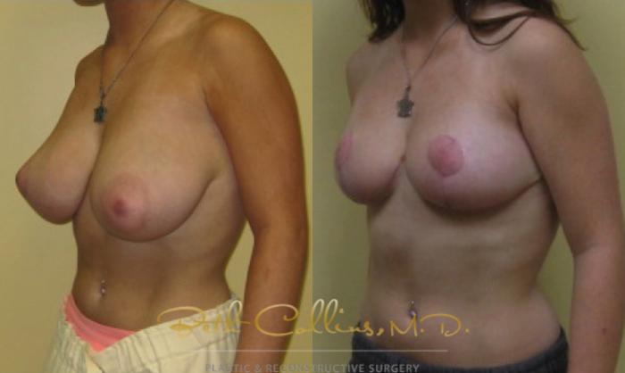 Before & After Breast Asymmetry Correction Case 22 View #4 View in Guilford, CT