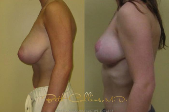 Before & After Breast Asymmetry Correction Case 22 View #5 View in Guilford, CT