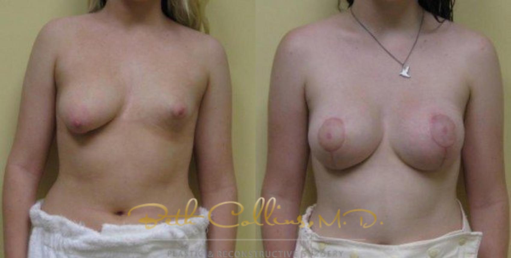 Before & After Breast Asymmetry Correction Case 23 View #1 View in Guilford, CT