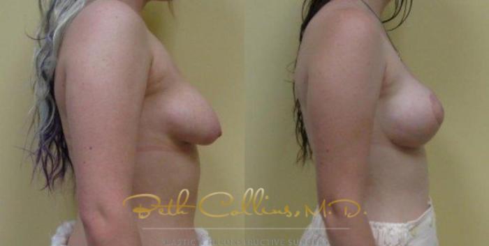 Before & After Breast Asymmetry Correction Case 23 View #2 View in Guilford, CT