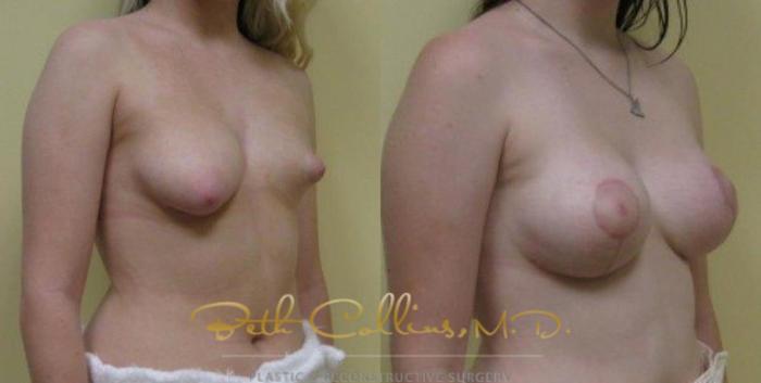 Before & After Breast Asymmetry Correction Case 23 View #3 View in Guilford, CT