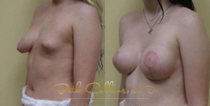 Before & After Breast Asymmetry Correction Case 23 View #5 View in Guilford, CT