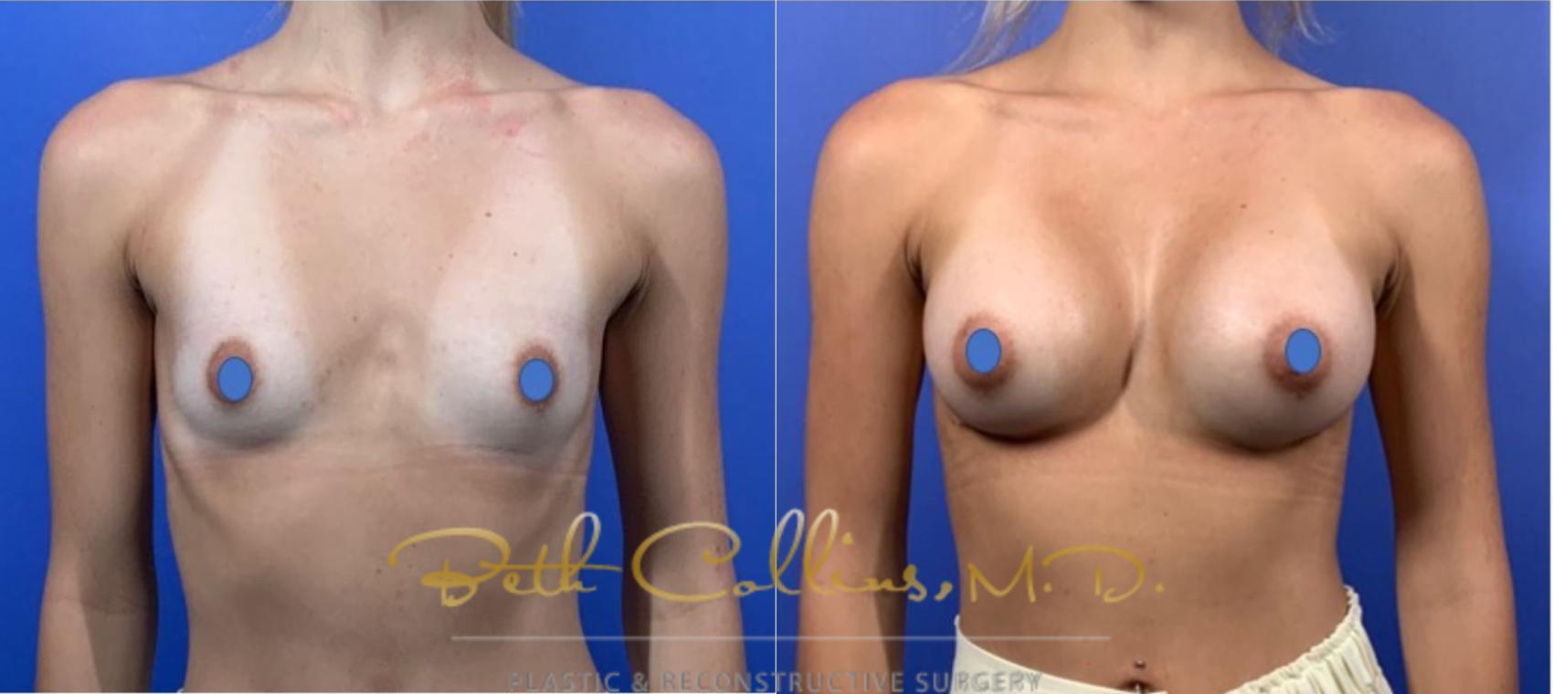 Before & After Breast Augmentation Case 124 View #1 View in Guilford, CT