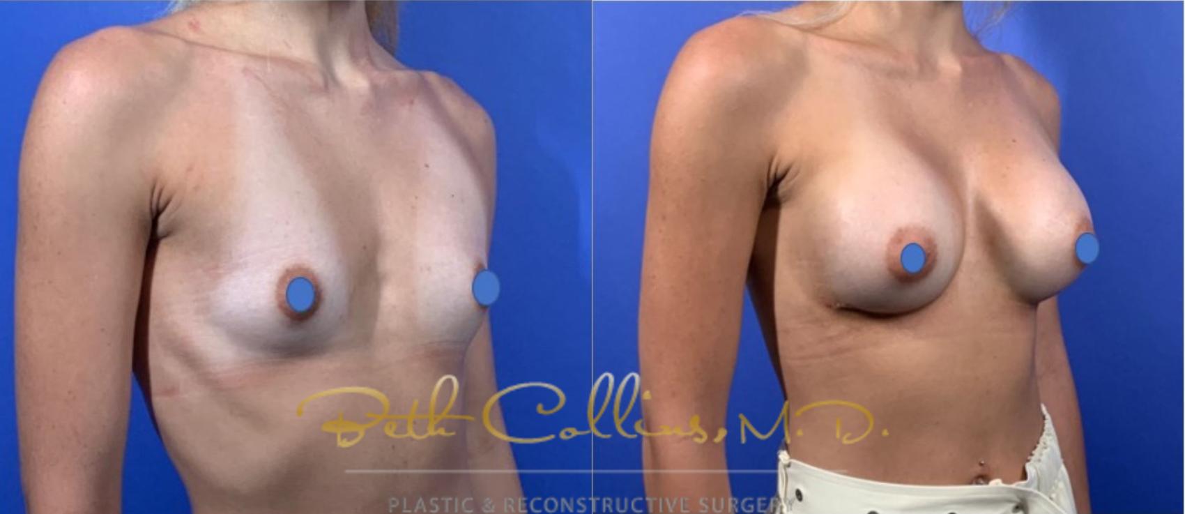 Before & After Breast Augmentation Case 124 View #2 View in Guilford, CT