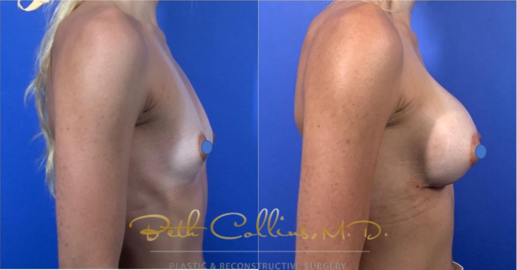 Before & After Breast Augmentation Case 124 View #3 View in Guilford, CT