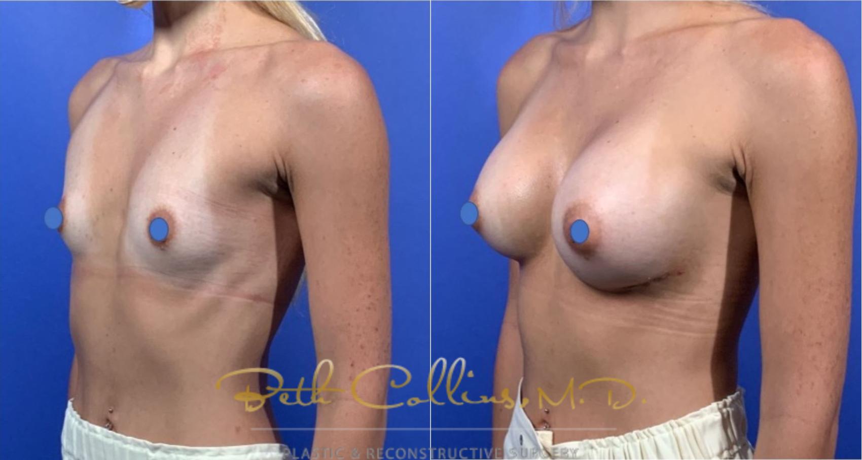 Before & After Breast Augmentation Case 124 View #4 View in Guilford, CT