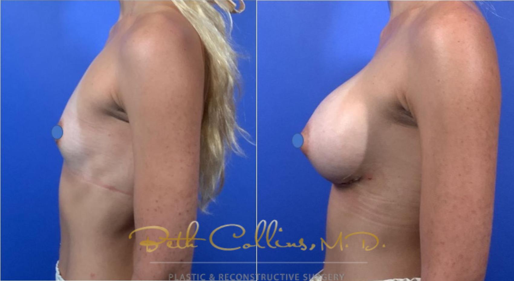 Before & After Breast Augmentation Case 124 View #5 View in Guilford, CT