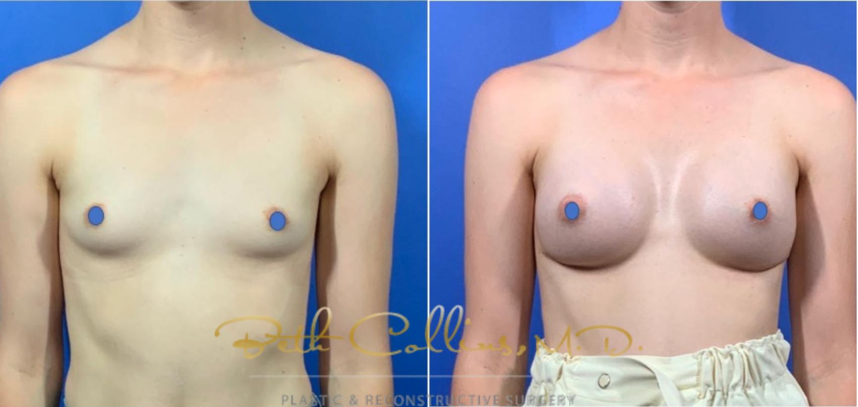 Before & After Breast Augmentation Case 125 View #1 View in Guilford, CT
